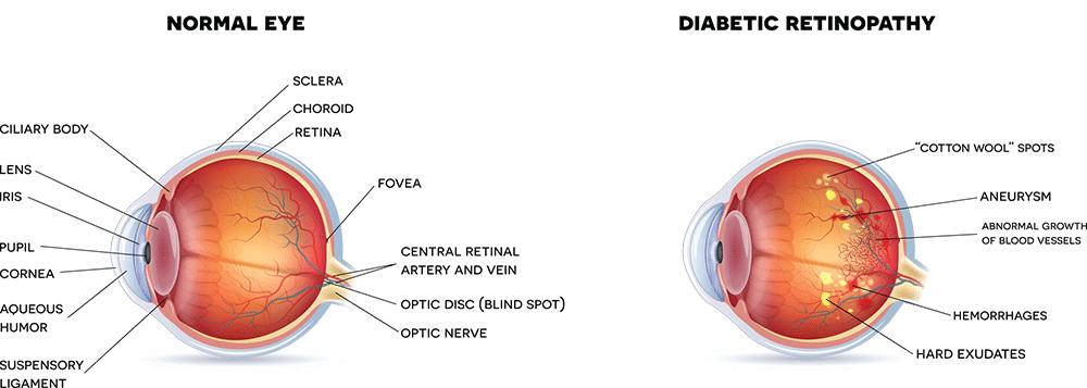illustrated cross sections of two human eyes, labeled with various parts, one featuring pupil, cornea, and retina, one with diabetic retinopathy containing small yellow spots, aneurysms, and hemorrhages
