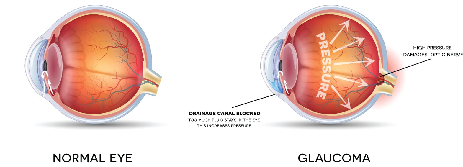 Normal eye vs. Eye with Glaucoma