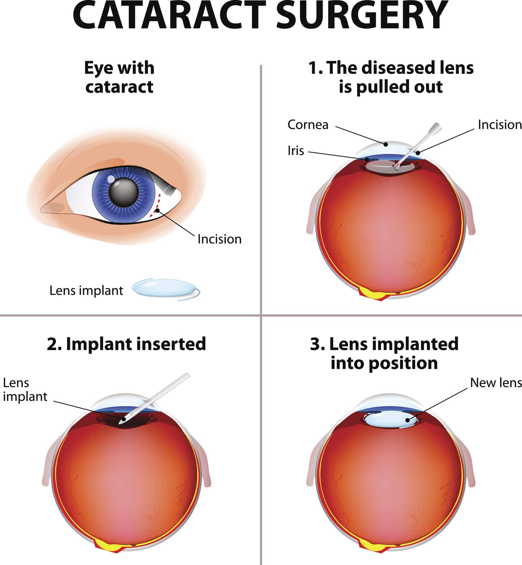 The Cataract Surgery process