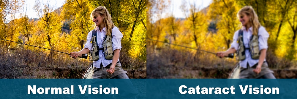Cataracts: Clear vision vs. Blurry vision