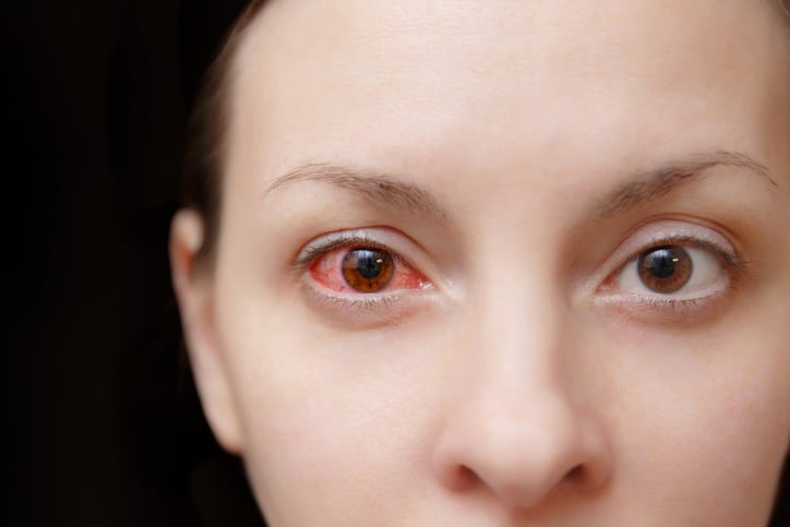 Handling Iritis - The Eye Clinic P.C.