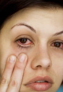Sick woman with iritis pulling down her eyelid to see red eyes.