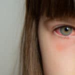 Pink eye Conjunctivitis in a girl's eye